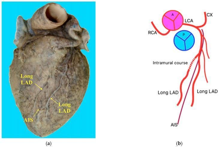 This educational image consists of a clinical photograph (a) and a schematic diagram (b) illustrating a dual left anterior descending (LAD) coronary artery variant. The photograph displays a dissected human heart specimen in the anterior view, highlighting the course of the coronary vasculature. Labeled structures include the Anterior Interventricular Sulcus (AIS) and two distinct 'Long LAD' branches descending parallel to each other. The schematic representation details the origin of these vessels from the Left Coronary Artery (LCA), alongside the Right Coronary Artery (RCA) and Circumflex Artery (CX). A critical anatomical feature demonstrated is the 'intramural course' of the right-sided LAD branch, where a portion of the vessel is embedded within the myocardium (myocardial bridge) before resurfacing. This variant is clinically significant for cardiothoracic surgery and interventional cardiology, as it represents a deviation from standard coronary anatomy (specifically resembling Pellegrini Type XIII) that can impact diagnostic interpretation and surgical planning for revascularization.
