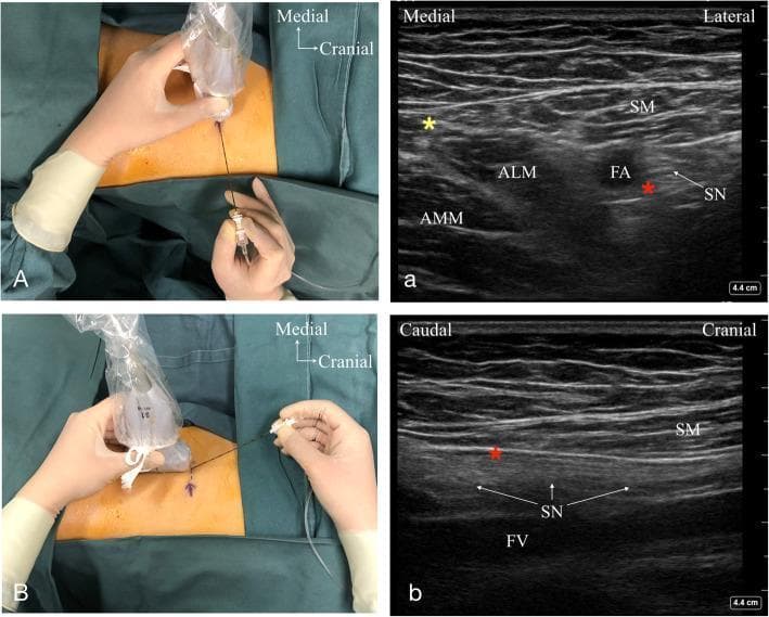 This composite educational image illustrates ultrasound-guided techniques for the Adductor Canal Block (ACB) at proximal and middle segments. Panels A and B are clinical photographs showing the ultrasound probe and needle orientation relative to the patient's medial thigh. Panels a and b are the corresponding ultrasound scans showing regional anatomy. Panel a (short-axis view) shows the proximal adductor canal, identifying the Sartorius Muscle (SM) superficially, with the Adductor Longus (ALM) and Adductor Magnus (AMM) muscles medially. The Femoral Artery (FA) and Saphenous Nerve (SN) are visible deep to the SM. A red asterisk marks the target endpoint for needle placement in the short axis. Panel b (long-axis view) demonstrates a longitudinal scan of the middle adductor canal, clearly delineating the linear trajectory of the Saphenous Nerve (SN) and the underlying Femoral Vein (FV). The educational focus is on the spatial relationships of neurovascular structures within the adductor canal and the use of dynamic scanning orientations to facilitate precise regional anesthesia.