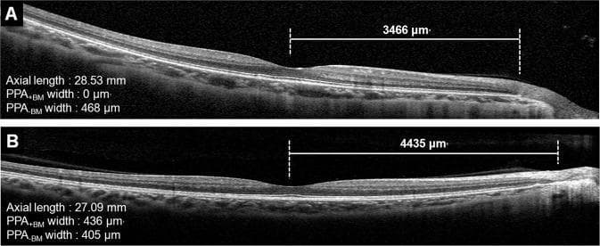 Educational diagnostic comparison using horizontal Spectral-Domain Optical Coherence Tomography (SD-OCT) B-scans of the retina in high myopia. The image displays two distinct cases, labeled A and B, focusing on the microstructural relationship between macular Bruch's membrane (BM) length and beta-parapapillary atrophy (β-PPA). Case A shows a myopic eye with an axial length of 28.53 mm, characterized by the presence of PPA without Bruch's membrane (PPA-BM = 468 μm) and the absence of PPA with Bruch's membrane (PPA+BM = 0 μm), resulting in a macular BM length of 3466 μm. Case B illustrates a myopic eye with a shorter axial length (27.09 mm) but a longer macular BM length (4435 μm), featuring both PPA+BM (436 μm) and PPA-BM (405 μm). Key anatomical landmarks visible include the foveal depression, retinal layers, retinal pigment epithelium (RPE), and the termination points of the BM. This comparison demonstrates that macular BM length can be longer in eyes with PPA+BM regardless of axial length, illustrating complex morphological changes in myopic globe elongation.