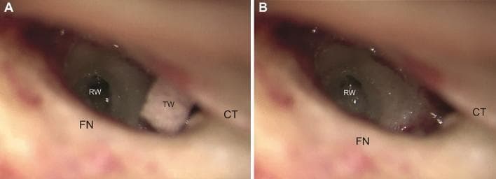 Side-by-side intraoperative clinical photographs (A and B) showing a microscopic view of the right ear round window (RW) niche through a facial recess approach. Image A (pre-drilling) demonstrates the surgical anatomy following cortical mastoidectomy and posterior tympanotomy, with the round window partially obscured by a bony overhang. Key landmarks include the facial nerve (FN) located inferiorly, the chorda tympani nerve (CT) positioned distally, and a tissue wipe (TW) placed for moisture control. Image B (post-drilling) illustrates the 'extended round window technique,' where antero-inferior drilling of the bony margin and crista fenestrae has been performed to optimize exposure for cochlear implant electrode insertion. This surgical modification provides a clearer, more direct line of sight into the scala tympani. The anatomical relationship between the facial nerve and chorda tympani remains constant, serving as the borders of the facial recess through which the middle ear is accessed. This comparison is essential for surgical training in otology and cochlear implantation.