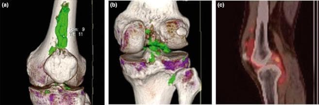This composite diagnostic image features three panels illustrating the left knee of a patient with chronic gouty arthritis. Panels (a) and (b) present 3D-reconstructed Dual-Energy Computed Tomography (DECT) scans in anterior and posterior views, respectively. The DECT software uses color-coding to identify monosodium urate (MSU) crystals, shown in green. Panel (a) clearly demonstrates a large, compact, elongated green tophus located in the suprapatellar region, extending superiorly from the patella. Panel (b) shows scattered green patches representing MSU deposits within the joint space and posterior structures. Panel (c) is a sagittal fusion image of Positron Emission Tomography and Computed Tomography (PET/CT). The red/orange heat map indicates intense 18F-fluorodeoxyglucose (FDG) uptake, signifying high metabolic activity and active inflammation associated with the urate tophi. These modalities collectively provide evidence of the metabolic burden and structural localization of tophaceous gout that may be occult on conventional radiography.