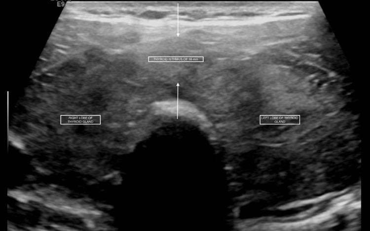 This diagnostic ultrasound image presents a transverse view of the thyroid gland, illustrating clinical signs of diffuse thyroid disease. The anatomy is clearly demarcated with labels for the 'RIGHT LOBE OF THYROID GLAND', 'LEFT LOBE OF THYROID GLAND', and the 'THYROID ISTHMUS'. The isthmus is significantly thickened, with a callout indicating a measurement of 16 mm, confirming thyromegaly. The parenchymal texture is notably heterogeneous and coarsely echogenic, showing a mixed pattern of hypoechoic and hyperechoic areas throughout both lobes. No discrete solid or cystic nodules are identified. The ultrasound findings are characteristic of diffuse thyroid enlargement, often associated with autoimmune conditions such as Graves' disease or Hashimoto's thyroiditis, particularly when correlating with the patient's reported history of hyperthyroidism. The image serves as an educational example of evaluating thyroid morphology, echotexture, and isthmic dimensions via sonography.