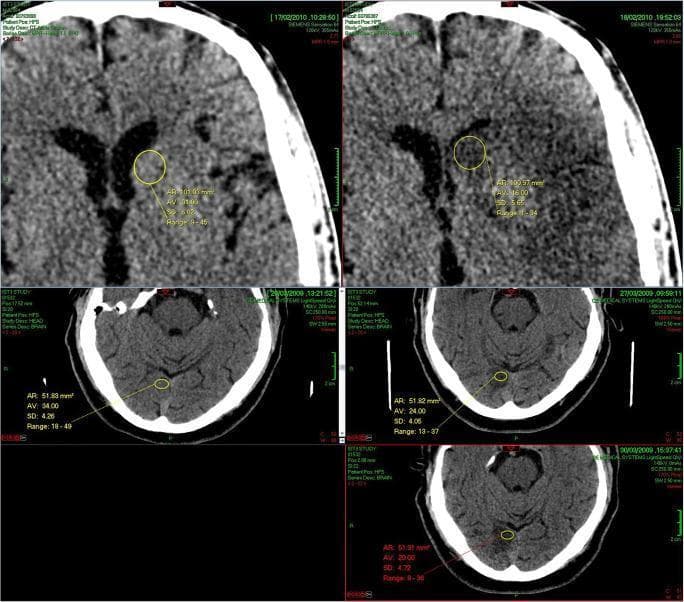 This Comparison Chart displays sequential non-contrast computed tomography (NCCT) scans of the brain from two patients to demonstrate the progression of ischemic stroke attenuation. The image is divided into upper and lower panels, each showing serial axial slices of developing infarcts. The upper panel tracks an evolving lesion near the lateral ventricle, comparing a scan at 175 minutes to one at 36 hours post-symptom onset. The lower panel displays three sequential scans (120 minutes, 22 hours, and 100 hours) showing the natural history of a posterior fossa infarct. Yellow circular Regions of Interest (ROIs) are manually placed within the hypoattenuating ischemic zones to measure Hounsfield Units (HU). These annotations quantify the progressive loss of tissue density (hypodensity) over time, characterized by darker visual texture and lower mean attenuation values as the cytotoxic edema matures. The visual material illustrates the clinical concept of using CT attenuation ratios to estimate the time of stroke onset, providing critical objective data for neuroradiological assessment and potential thrombolytic eligibility in acute stroke management.