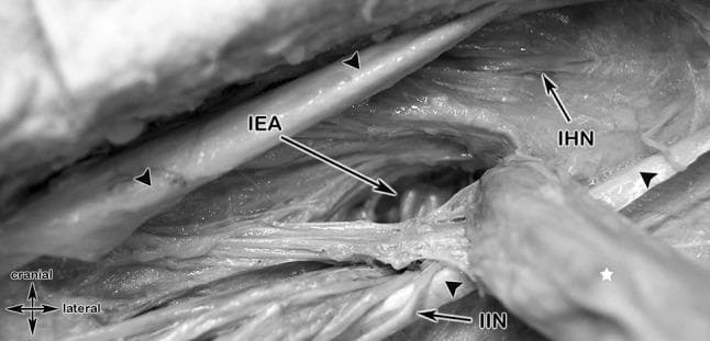 This grayscale clinical photograph of a cadaveric dissection illustrates the surgical anatomy of the inguinal region, specifically highlighting the topographic relationships during an indirect inguinal hernia repair. The dissection reveals the inferior epigastric artery (IEA) running cranially and medially. Lateral and inferior to the IEA, an indirect inguinal hernia is visible, marked with a white star, having protruded through the deep inguinal ring lateral to the epigastric vessels. Key neural structures are identified: the iliohypogastric nerve (IHN) is positioned superomedially to the hernia, while the ilio-inguinal nerve (I-IN) runs inferior and lateral to the IEA, passing toward the superficial inguinal ring. Black arrowheads delineate the reflected edges of the external oblique aponeurosis. The image provides critical educational context regarding the 'triangle of pain' and the importance of identifying these neurovascular structures to avoid iatrogenic injury during herniorrhaphy. The anatomical orientation is provided by a 'cranial/lateral' directional indicator, emphasizing the spatial arrangement of the spermatic cord structures and the transversalis fascia.