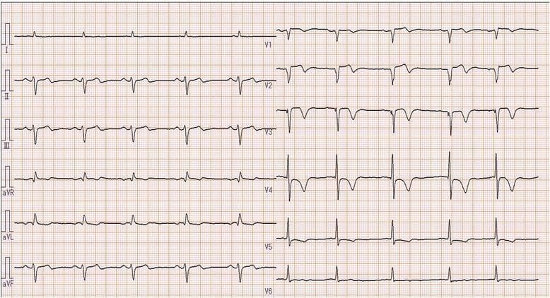 A standard 12-lead preoperative electrocardiogram (ECG) printed on grid paper, displaying limb leads (I, II, III, aVR, aVL, aVF) and precordial leads (V1-V6). The tracing demonstrates several ischemic findings. In the anterior precordial leads (V1-V3), there is a slight elevation of the ST segment above the isoelectric baseline. The morphology of the T-waves in these leads appears flattened or slightly inverted. In the lateral leads (V4-V6), the ST segment becomes more isoelectric, though abnormal ST-T wave morphology persists across V2-V6. Additionally, lead aVL shows a prominent T-wave inversion. The limb leads (II, III, aVF) demonstrate minor ST-segment abnormalities and non-specific T-wave changes. The QRS complexes exhibit relatively normal duration and voltage, though poor R-wave progression is noted in the early precordial leads. These findings are clinically significant as they suggest possible myocardial ischemia or injury affecting the anteroseptal and lateral regions of the heart, consistent with the patient's history of coronary artery disease.
