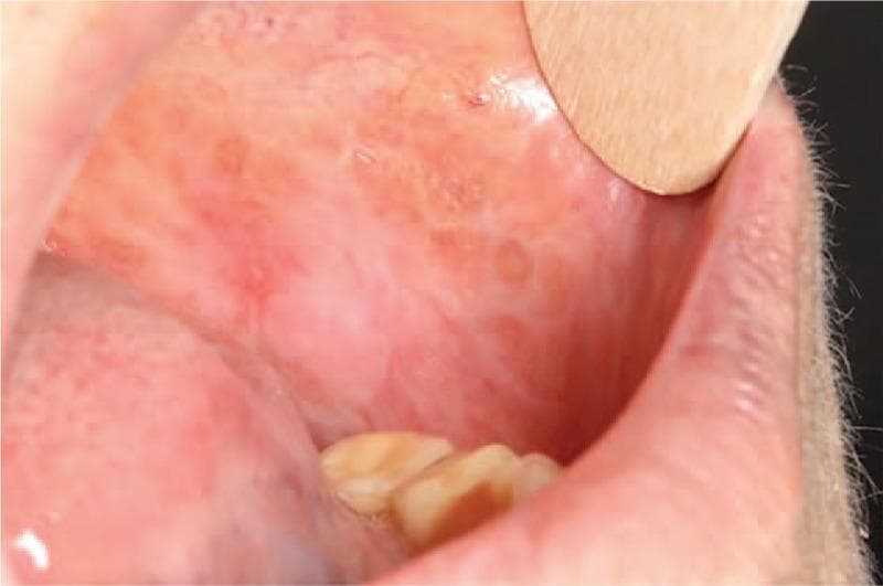 This clinical photograph displays an intraoral view of the left buccal mucosa, highlighting manifestations of oral lichen planus. The mucosa exhibits a characteristic mixed appearance featuring both reticular and atrophic elements. Predominant white, interlacing striae (Wickham striae) form a fine, web-like reticular pattern across a background of erythematous, thinned (atrophic) tissue. The affected area shows signs of chronic inflammation without overt ulceration or erosions. A wooden tongue depressor is visible in the upper right quadrant of the frame, retracting the lip for better visualization of the oral cavity. This image serves as a representative example of oral lichen planus, illustrating the key morphological features used to differentiate subtypes and monitor disease progression in oral medicine and dermatology.