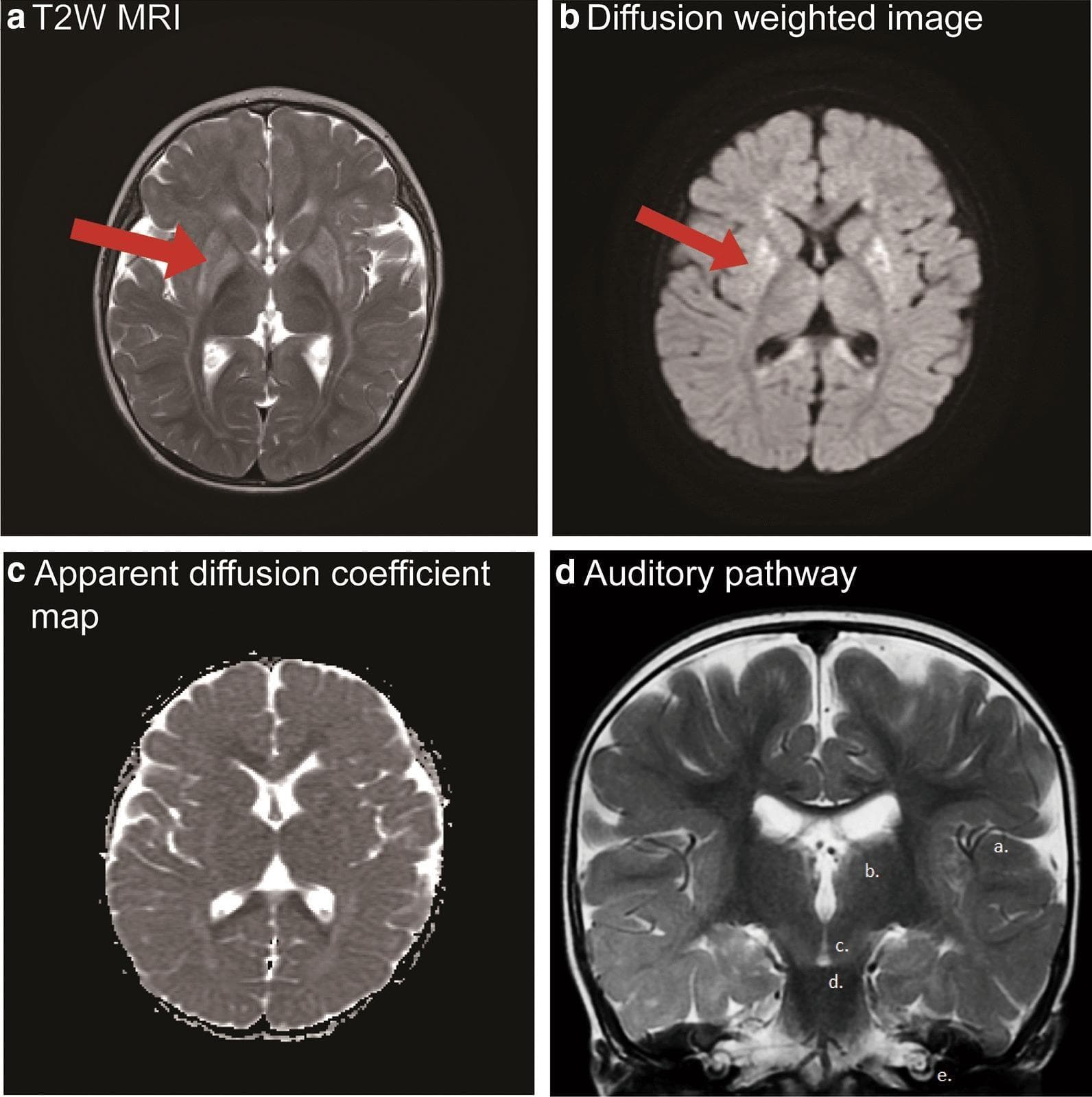 This composite figure presents brain magnetic resonance imaging (MRI) findings in Glutaric Aciduria Type 1 (GA-1). Panels A, B, and C provide axial views demonstrating characteristic basal ganglia injury. Panel A (T2-weighted MRI) shows bilateral, extensively hyperintense signal in the striatum, specifically the putamen (red arrow). Panel B (Diffusion-weighted imaging, DWI) reveals hyperintense signal indicating elevated diffusion in the dorsolateral putamen. Panel C (Apparent Diffusion Coefficient, ADC map) shows minimal restricted diffusion in the bilateral putamen, corresponding to the findings in A and B. Panel D is an oblique coronal T2-weighted section labeled to illustrate the central auditory pathway anatomy: (a) auditory cortex, (b) medial geniculate body of the thalamus, (c) inferior colliculus in the midbrain, (d) superior olivary nucleus in the pons, and (e) cochlea. This panel demonstrates the absence of space-occupying lesions along the auditory tracts and the characteristic hypointense appearance of white matter tracts in a pediatric patient. The imaging collectively highlights metabolic-induced neurotoxicity in the basal ganglia and provides a structural evaluation of the hearing apparatus.