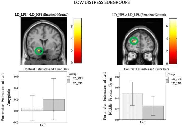This medical visual consists of two sets of statistical parametric maps (SPM) and corresponding bar graphs illustrating neural activation patterns in low distress (LD) subgroups during emotional processing. The imaging utilizes functional MRI (fMRI) data overlaid on structural brain templates. The left panel shows the LD_LPS > LD_HPS (Emotion > Neutral) comparison, highlighting a localized cluster of activation in the left amygdala (circled in green), with an accompanying bar graph showing higher contrast estimates for the LPS group. The right panel demonstrates the reverse comparison, LD_HPS > LD_LPS, revealing significant activation in the left middle frontal gyrus (circled in green), with the corresponding bar graph indicating higher estimates for the HPS group. Activation intensity is indicated by a color-coded heat scale ranging from 0 to 6. This infographic serves as an educational tool for neuroscientific research into limbic and frontal lobe engagement during auditory emotional stimuli, specifically within the context of psychological distress variables.