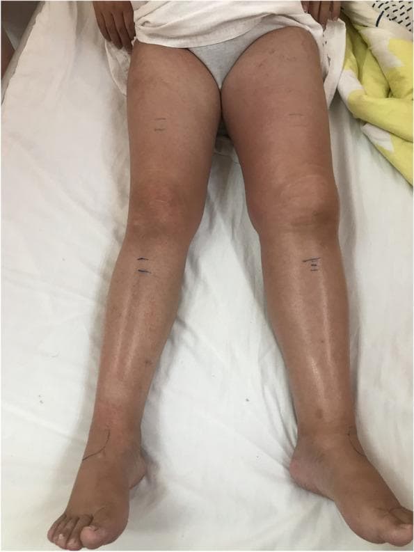 This clinical photograph shows a front-on view of a patient’s lower extremities while lying supine. The image demonstrates relatively symmetrical anatomy with no gross muscular atrophy or significant pitting edema visible. Both legs exhibit minor skin irregularities, including subtle variations in pigmentation and prominent superficial veins in the lower legs. Notably, surgical or diagnostic skin markings (short horizontal lines) are present on the bilateral mid-thighs and shins, and a curved marking is visible on the dorsal aspect of the left ankle. Clinically, these findings are consistent with a pre-diagnostic physical examination for suspected vascular pathology. The left lower extremity appears to have slightly more pronounced skin tone variation compared to the right. In the context of the patient's history, these physical findings precede diagnostic confirmation of a left external iliac vein occlusion, likely related to extrinsic compression or pregnancy-related venous changes such as May-Thurner syndrome.