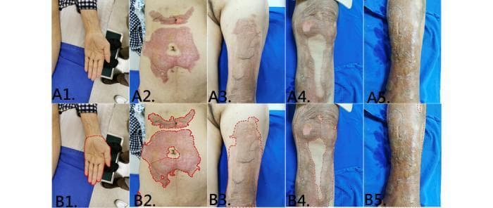 This composite of clinical photographs illustrates various burn injuries and skin lesions across multiple anatomical regions, paired with corresponding segmentation masks (B1-B5) used for Total Body Surface Area (TBSA) estimation. A1 displays a supinated left hand and palm used as an anatomical reference for sizing. A2 focuses on the abdomen, showing a large, irregularly shaped partial-thickness burn characterized by a pink-to-red erythematous base with areas of central pallor, suggesting varying burn depths. A3, A4, and A5 depict injuries on the left thigh, right leg/knee, and left lower leg, respectively. These areas exhibit extensive post-inflammatory hyperpigmentation, mottled tan-to-brown discoloration, and varying textures ranging from smooth to glossy or dry, characteristic of healing burn wounds or hypertrophic scarring. The series demonstrates the application of machine learning (Mask R-CNN) in dermatology and burn surgery to accurately delineate wound boundaries (red dashed lines in row B) for objective clinical assessment and treatment planning.