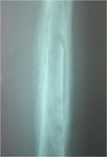 This diagnostic radiograph of a long bone demonstrates classic features of chronic haematogenous osteomyelitis, specifically classified as Beit CURE Type B2. The image reveals a central sequestrum, which is an isolated piece of necrotic, devascularized bone appearing as an area of increased radiopacity within the medullary canal. Surrounding the sequestrum is a well-defined involucrum, representing a layer of new periosteal bone formation. This involucrum appears structural and relatively normal in morphology, indicating that it is sufficiently stable to maintain the bone's integrity despite the underlying infection. The radiological presentation illustrates the characteristic pathological progression of chronic osteomyelitis where the body attempts to wall off infected necrotic tissue with a sheath of living bone. The image is an essential educational example for orthopedic surgery and radiology, highlighting the distinction between necrotic sequestrum and regenerative involucrum.