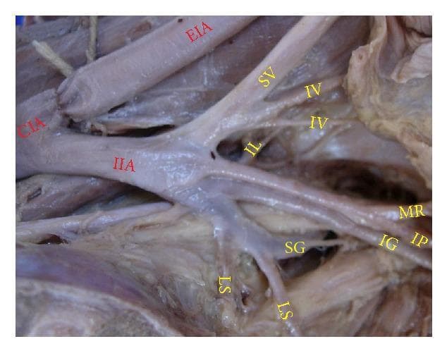 Anatomical dissection photograph of a left pelvic half demonstrating the branching morphology of the internal iliac artery (IIA). The image shows the common iliac artery (CIA) bifurcating into the external iliac artery (EIA) and the IIA. This specific specimen exhibits a direct branching pattern where the IIA terminates into a 'spray' of multiple vessels rather than distinct anterior and posterior trunks. Key visceral and parietal branches are labeled, including the superior vesical (SV), inferior vesical (IV), lateral sacral (LS), and iliolumbar (IL) arteries. Notably, the superior gluteal artery (SG) originates independently from the IIA, while the inferior gluteal artery (IG) and internal pudendal artery (IP) share a common trunk before bifurcating, representing a Type Ia variation. Other visible structures include the middle rectal artery (MR). This visual is highly relevant for medical education in surgical anatomy, particularly for understanding pelvic vascular variations essential for gynecological, urological, and orthopedic procedures.