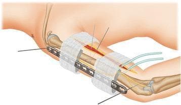 This orthopaedic schematic diagram illustrates the surgical application of a Locking Compression Plate (LCP) utilized as an external fixator for a humeral shaft fracture. The illustration depicts the humerus with a mid-shaft fracture being stabilized by a multi-hole LCP positioned along the lateral aspect of the arm. Key surgical details shown include the use of 2.0 mm Kirschner wires (K-wires) inserted through the most proximal and distal plate holes into the bone cortex for temporary fixation and alignment. A critical feature of the externalized plate technique is demonstrated by a stack of folded towel spacers placed between the plate and the skin surface, ensuring adequate clearance to accommodate soft tissue swelling while maintaining a parallel orientation to the long bone. The diagram also shows the proximity of anatomical structures, such as the radial nerve, and surgical components like drainage tubes and incision sites. This educational visual is intended for orthopaedic residents and surgeons to understand the stabilization logic of using an internal fixation plate in an external fixator configuration for managing complex or infected nonunions.