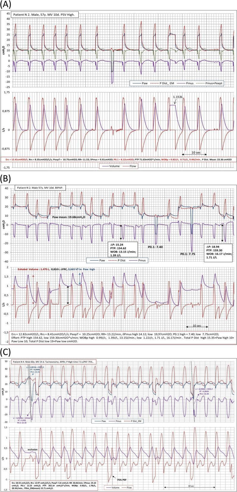 This physiological monitoring graphic displays mechanical ventilation waveforms across three distinct modes: Pressure Support Ventilation (PSV) in panel A, Biphasic Positive Airway Pressure (BIPAP) in panel B, and Airway Pressure Release Ventilation (APRV) in panel C. Each panel illustrates time-synced tracings of airway pressure (Paw), muscle pressure (Pmus), distending pressure (PDist_EM), flow (L/s), and tidal volume (L). In PSV (A), the waveforms show regular, patient-triggered breaths with stable tidal volumes and consistent Pmus deflections. BIPAP (B) reveals two levels of baseline pressure with significant spontaneous effort (negative Pmus) during the lower pressure phase, resulting in more variable flow and volume patterns. APRV (C) demonstrates prolonged high-pressure phases with brief releases, characterized by high respiratory drive and frequent, irregular spontaneous breathing efforts superimposed on the ventilator cycle. Key metrics provided below the graphs include respiratory system elastance (Ers), airway occlusion pressure (P0.1), and patient work of breathing (WOBp), used to analyze patient-ventilator synchrony and inspiratory effort in critically ill patients, such as those with COVID-19 ARDS.