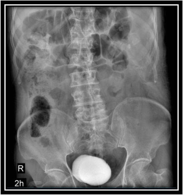 This diagnostic image is an anterior-posterior (AP) abdominal radiograph depicting an Intravenous Pyelogram (IVP) taken 2 hours after the administration of intravenous iodine contrast. The image captures the lower abdomen and pelvic region, focusing on the urinary system. Significant radiopaque contrast medium is concentrated within the urinary bladder, appearing as a dense, ovoid, well-defined structure in the midline pelvis. Faint traces of contrast are visible in the collecting system of the left kidney, indicating renal excretion. Skeletal landmarks are clearly visualized, including the lumbar vertebrae, sacroiliac joints, iliac crests, and pubic symphysis. Intestinal gas patterns are superimposed over the abdominal cavity. This modality is used in urology to evaluate the structural integrity and functional drainage of the kidneys, ureters, and bladder, particularly in cases of hematuria or suspected trauma. The 2-hour delay allows for the assessment of the bladder filling phase and ensures no significant obstruction or extravasation is present.