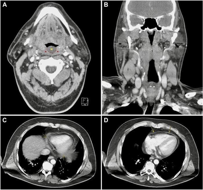 This composite diagnostic image features four panels of contrast-enhanced computed tomography (CT) scans illustrating clinical manifestations of infectious mononucleosis (Epstein-Barr virus). Panel A shows a transverse view of the oropharynx, identifying bilateral tonsillar thickening and edema (red asterisks) alongside a thickened, edematous uvula (yellow asterisk). Panel B presents a coronal view of the neck, highlighting prominent, reactive cervical lymphadenopathy. Panels C and D are transverse sections of the thorax at the level of the heart, demonstrating a trace pericardial effusion. Yellow arrows point to abnormal enhancement and thickening of the pericardial sac, indicating inflammatory pericarditis. The collection serves as an educational resource for identifying multisystem involvement of EBV, ranging from exudative pharyngitis and regional lymphadenopathy to secondary cardiac complications such as pericarditis. This material is suitable for medical education in radiology, infectious disease, and emergency medicine specialties.