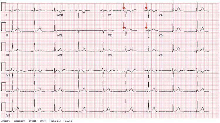 A standard 12-lead electrocardiogram (ECG) recorded at 25 mm/s and 10 mm/mV, demonstrating sinus bradycardia at approximately 53 beats per minute. The tracing shows consistent P waves (highlighted with red arrows in leads V1, V2, V4, and V5) preceding each QRS complex, indicating a transition from a previous junctional rhythm to a normal sinus rhythm. The QRS complexes are narrow and exhibit normal morphology, with positive deflections (dominant R waves) in leads I, II, aVF, and V4-V6. Lead aVR shows a characteristic negative deflection. T waves are upright in the lateral and inferior leads and appropriately inverted in aVR. The image serves as a clinical example of sinus rhythm resolution following a transient arrhythmia. The transition to sinus rhythm is evidenced by the clear P-wave morphology and consistent PR intervals across the limb and precordial leads.
