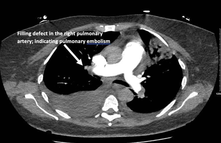 This diagnostic image is an axial contrast-enhanced CT pulmonary angiography (CTPA) of the thorax at the level of the main pulmonary artery bifurcation. The primary finding is an intraluminal filling defect located within the right pulmonary artery, indicated by a white arrow and text annotation, which is diagnostic of a pulmonary embolism (PE). This defect appears as a hypoattenuating area surrounded by hyperattenuating contrast medium within the vessel lumen. Additionally, there is evidence of bilateral pleural effusions, more pronounced on the right side, appearing as dependent, crescent-shaped areas of fluid attenuation in the posterior pleural spaces. The image demonstrates the hallmark radiological signs used in the emergency diagnosis of venous thromboembolism and associated thoracic fluid collections. It is intended for medical education regarding radiological manifestations of pulmonary vascular disease and secondary complications such as pleural fluid accumulation.