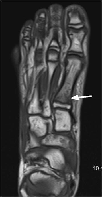 This diagnostic image is an axial T1-weighted turbo spin-echo (TSE) MRI scan of the human foot, focusing on the midfoot and forefoot anatomy. The scan clearly depicts the metatarsals, tarsal bones including the cuneiforms and navicular, and surrounding soft tissue structures. A prominent white arrow points to the base of the first metatarsal, where a distinct, low-signal intensity linear discontinuity is visible. This finding is characteristic of a cortical fracture at the base of the first metatarsal bone. The image illustrates a common pediatric or orthopedic trauma scenario, often associated with high-impact activities like trampoline use. The visualization of the fatty marrow signal on T1-weighted imaging provides high anatomical detail, allowing for the identification of structural disruptions in the cortical bone. This content is suitable for medical education regarding musculoskeletal radiology, particularly in the diagnosis of occult or acute foot fractures.