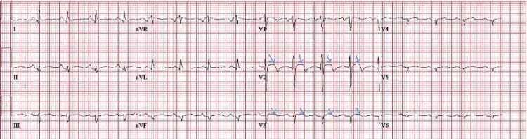 This diagnostic image is a 12-lead electrocardiogram (ECG) tracing recorded on standard grid paper. The tracing demonstrates a sinus rhythm with several clinically significant morphological abnormalities. Blue arrows highlight mild ST-segment elevations specifically in the precordial leads V2 and V3. Additionally, pathological Q-waves are evident in the lateral leads, suggesting potential myocardial injury or sequelae. T-wave morphology varies across the leads, with notably peaked T-waves in V2 and V3, while polarity remains positive in leads I, II, aVF, and V4-V6. The R-wave amplitude appears relatively preserved, though there is poor R-wave progression across the precordial leads. This ECG pattern is visually indicative of myocarditis, particularly in clinical scenarios where obstructive coronary artery disease has been ruled out. It serves as an educational example of immunotherapy-induced cardiotoxicity, such as that seen with immune checkpoint inhibitors like pembrolizumab, illustrating how non-ST-elevation myocardial infarction (NSTEMI) or inflammatory myocarditis can present with subtle ST-segment and T-wave changes.