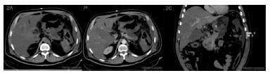 This diagnostic imaging series consists of axial and coronal abdominal Computed Tomography (CT) scans highlighting severe acute necrotizing pancreatitis and secondary gastric involvement. Figure 2A (axial unenhanced) and 2B (axial contrast-enhanced) demonstrate a slightly enlarged pancreatic body and tail with a notable absence of contrast enhancement, a hallmark of pancreatic necrosis. Peripancreatic fat stranding and inflammatory changes are evident. Figure 2C (coronal enhanced) reveals a markedly thickened and unenhanced gastric wall, consistent with gastric wall necrosis. A fluid collection is localized near the posterior gastric wall, representing a pancreatic-peripancreatic inflammatory collection. These findings are critical for diagnosing complications of severe acute pancreatitis, specifically necrotizing changes and secondary ischemia or necrosis of the adjacent stomach wall. The image is optimized for teaching radiological signs of abdominal organ necrosis and the spatial relationship between the pancreas and the posterior stomach.