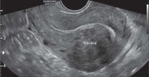 This diagnostic image is a transvaginal ultrasound (TVUS) showing a longitudinal view of a retroverted uterus. A prominent uterine leiomyoma (fibroid) is clearly visible and labeled within the anterior wall. The lesion is characterized as a solid, round, and well-defined mass. Visually, it presents as hypoechoic relative to the surrounding myometrium with a heterogeneous internal echo texture. According to the FIGO classification system for uterine fibroids, this is a type 2 submucosal fibroid, meaning it is partially intramural but has a significant component (at least 50%) projecting into the endometrial cavity, resulting in the displacement of the endometrial line. This imaging is clinically significant for evaluating causes of abnormal uterine bleeding and infertility, and for preoperative planning of hysteroscopic myomectomy.