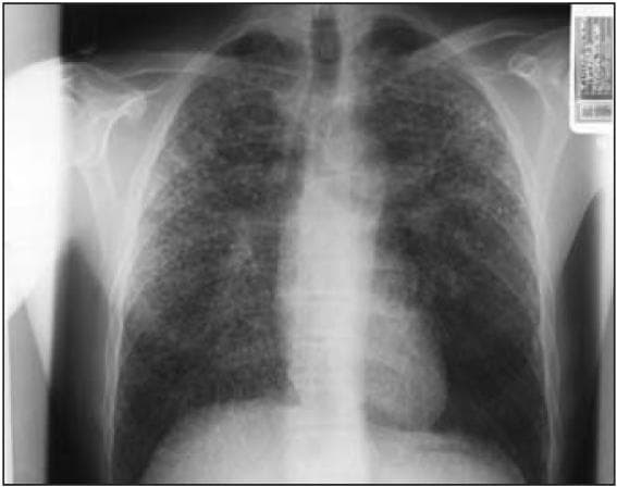This diagnostic image is a postero-anterior (PA) chest X-ray demonstrating a diffuse, extensive, and bilateral regular-nodular infiltrate throughout both lung fields. The opacities are characterized by small, rounded nodules, many measuring between 1.5 mm and 10 mm (ILO classification q/r). There is a high profusion of these small opacities (3/3) distributed from the apices to the bases, with visible coalescence of smaller opacities into larger conglomerates, particularly in the upper lobes. No significant pleural abnormalities, effusions, or large isolated opacities are visually apparent. The mediastinal and cardiac silhouettes appear within normal limits on this projection. This radiographic pattern is highly suggestive of interstitial lung disease or pneumoconiosis, serving as a key educational example for recognizing occupational lung disease patterns such as silicosis or berylliosis.
