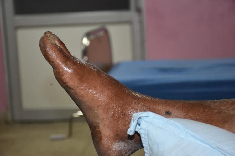 This clinical photograph displays the right foot and ankle of a patient in a medical setting, following a reported snakebite. The foot exhibits moderate diffuse swelling (edema). The skin is coated in a thick, shiny, and viscous amber-colored substance, identified as honey, which was applied as a traditional first-aid remedy prior to hospital arrival. A high specular light reflection is visible across the dorsal and lateral surfaces of the foot due to the topical application. There is a dark, circular lesion or puncture mark on the lateral aspect of the distal lower leg, near the ankle joint, potentially representing the bite site. The ankle is partially covered by a light blue medical cloth. This image illustrates traditional pre-hospital practices and local wound management for snakebite envenomation in a clinical context, highlighting the intersection of traditional medicine and emergency medical care.