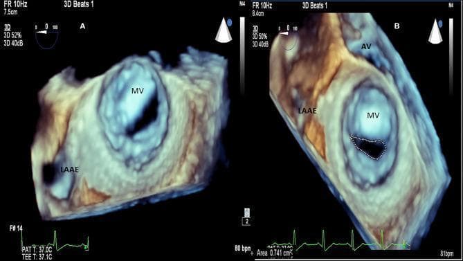 This 3D transesophageal echocardiography (TEE) image provides a surgical or 'en-face' view of the mitral valve (MV) in a patient with Rheumatic Heart Disease (RHD). Panel A demonstrates the classic 'fishmouth' or 'buttonhole' appearance of the mitral valve orifice, a hallmark of severe mitral stenosis. The visual shows significant thickening of the valvular leaflets and commissural fusion, which restricts normal diastolic opening. Adjacent to the mitral valve, the left atrial appendage (LAAE) is clearly visible. Panel B illustrates the clinical application of 3D planimetry to quantify the severity of the stenosis. A dotted line traces the restricted mitral valve area (MVA), with a measured value of 0.741 cm², indicating severe mitral stenosis (typically defined as <1.0 cm²). The aortic valve (AV) is also visualized in Panel B, providing anatomical context for the spatial relationship between the valves. This diagnostic image is used in cardiology to assess valvular morphology and plan interventions such as balloon valvuloplasty or valve replacement.