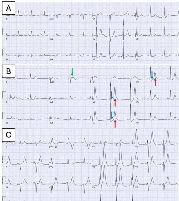 This diagnostic image consists of three sequential 12-lead electrocardiograms (ECGs) labeled A, B, and C, illustrating the dynamic evolution of the de Winter ECG pattern. Panel A serves as a baseline showing sinus rhythm. Panels B and C demonstrate the diagnostic progression of this ST-elevation myocardial infarction (STEMI) equivalent. Key features highlighted with colored arrows in panel B include: upsloping ST-segment depression (>1 mm) at the J-point in the precordial leads V2-V4 (blue arrows), tall, prominent, and symmetrical 'hyperacute' T-waves in leads V2-V5 (red arrows), and reciprocal ST-segment elevation in lead aVR (green arrow). The sequences illustrate the classic absence of typical ST-segment elevation in the precordial leads despite proximal left anterior descending (LAD) artery occlusion. This series is an essential educational tool for identifying rare but critical patterns of acute myocardial ischemia and differentiating them from benign early repolarization or hyperkalemia.