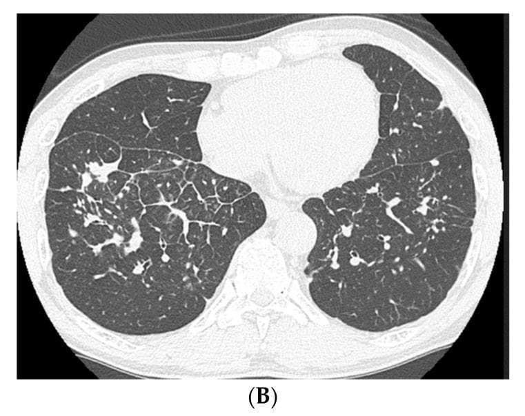 This diagnostic image is an axial slice from a High-Resolution Computed Tomography (HRCT) scan of the chest. It demonstrates bilateral lung parenchyma with a focus on the middle and lower lobes. The primary pathology consists of multiple, well-defined nodular shadows with a centrilobular and perilobular distribution. There is visible thickening of the intralobular septa, creating a reticulonodular pattern characteristic of interstitial lung disease or pneumoconiosis. The nodules are scattered throughout both lung fields but show higher density in the posterior segments. Key anatomical landmarks visible include the heart in the anterior mediastinum, the descending aorta, the main bronchi, and the ribs forming the thoracic cage. The image serves as a clinical illustration of disease progression and regression in a patient with pneumoconiosis and a sarcoid-like reaction, highlighting the importance of nodular morphology and septal thickening in diagnosing occupational lung diseases.