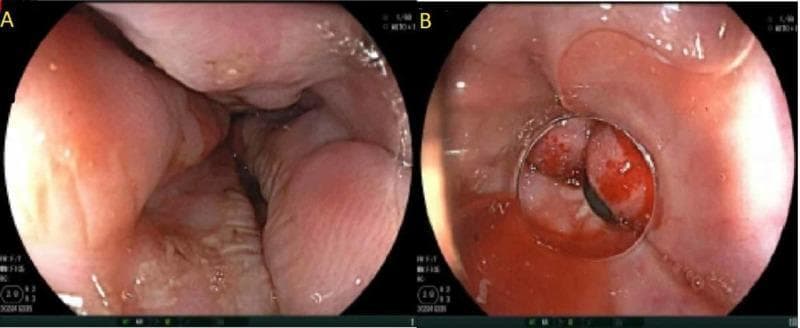 This endoscopic clinical photograph consists of two panels illustrating the management of esophageal varices. Panel A shows Grade 3 esophageal varices, characterized by large, tortuous, and distended submucosal veins protruding significantly into the esophageal lumen. The varices appear congested with an irregular surface and visible 'red wale' markings, indicating a high risk of imminent hemorrhage. Panel B demonstrates the status post-endoscopic variceal ligation (EVL). A rubber band is seen encircling and strangulating a varix, resulting in localized tissue congestion and a dark, thrombosed appearance within the band. This therapeutic intervention is performed to achieve hemostasis and induce subsequent fibrosis of the varix. The surrounding esophageal mucosa appears intact with no signs of active spurting hemorrhage. These images are essential for teaching endoscopic grading of portal hypertension manifestations and the technical execution of variceal banding.