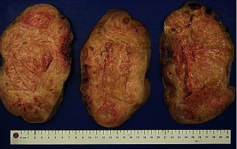 This clinical photograph displays a gross specimen of a uterine leiomyoma (uterine fibroid) that has been sectioned into three portions to reveal the internal architecture. The cut surfaces exhibit a characteristic whorled or trabecular growth pattern, consisting of interlacing bundles of smooth muscle and fibrous connective tissue. The color is predominantly a pale yellowish-tan, with notable focal areas of reddish discoloration suggesting vascularity or intramural hemorrhage. The texture appears dense and firm, although small cystic spaces or translucent regions are visible, indicating focal cystic or hydropic degeneration. The specimens are displayed against a blue background with a metric ruler for scale, demonstrating a significant size (approximately 10-12 cm in diameter per section). This image serves as an educational tool for identifying the macroscopic features of benign uterine smooth muscle tumors and their potential secondary degenerative changes.