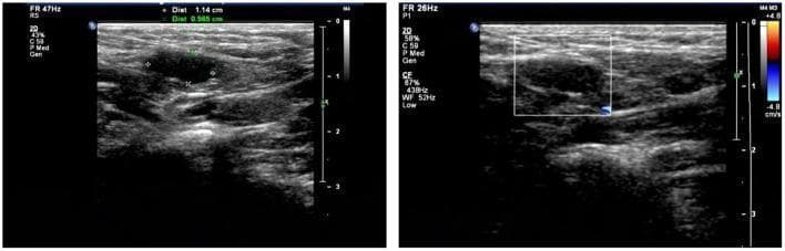 This diagnostic image displays two side-by-side grayscale ultrasonography panels of the inguinal/scrotal region, used to evaluate bilateral cryptorchidism. The left panel shows a longitudinal 2D ultrasound view of an undescended testis, appearing as an oval, hypoechoic, heterogeneous mass measured at approximately 1.14 cm by 0.565 cm. Caliper markers delineate the length and width of the structure within the surrounding soft tissue. The right panel displays the same region using color Doppler imaging, indicated by a rectangular sampling box and a velocity scale (+4.8 to -4.8 cm/s). Small focal areas of blue and red within the sampling box represent blood flow within the testicular parenchyma. Instrument parameters are visible on the left margin, including a frame rate (FR) of 47Hz for the 2D image and 26Hz for the Doppler study. These images demonstrate the classic sonographic appearance of small, extra-scrotal gonads, serving as a primary diagnostic tool for locating non-palpable testes in pediatric patients.