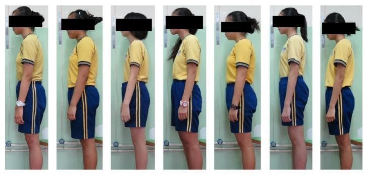 A series of seven lateral clinical photographs showing the habitual standing postures of female adolescents aged 10–13. The image illustrates various postural deviations common in musculoskeletal screening, including forward head posture (anterior translation of the head relative to the shoulders), rounded shoulders, and variations in spinal sagittal alignment such as thoracic kyphosis and flat back. Each subject is viewed from the side to demonstrate the relationship between the cervical, thoracic, and lumbar regions. The visual serves to distinguish between neutral spinal alignment—where the ear is aligned over the shoulder and hip—and postural impairments that may be associated with signs of scoliosis or muscle activity imbalances. Key clinical features shown include the degree of cervical lordosis, thoracic curvature, and shoulder elevation, which are used in orthopedic assessments to screen for spinal conditions and determine the need for further diagnostic intervention like the Adam's forward bending test or angle of trunk rotation (ATR) measurement.