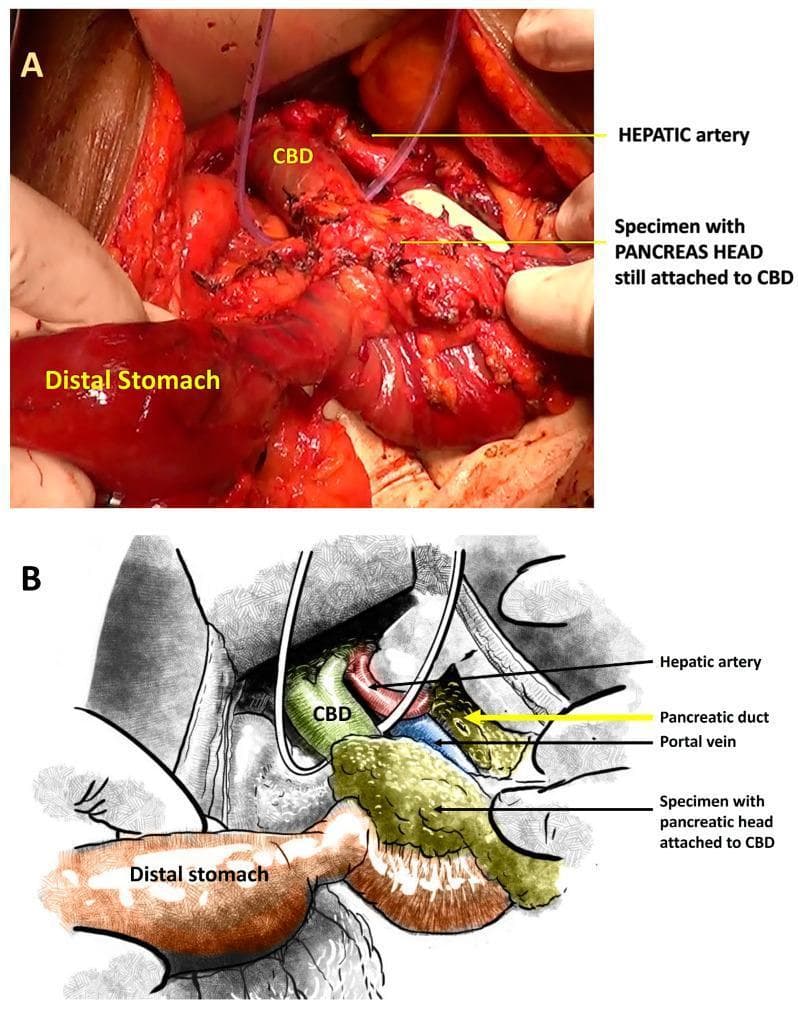 Educational panel illustrating hepatobiliary surgical anatomy during a pancreaticoduodenectomy (Whipple procedure). Image A is an intraoperative clinical photograph displaying a surgical specimen consisting of the pancreatic head remaining attached to the common bile duct (CBD), positioned adjacent to the distal stomach. Visible medical elements include surgical sutures on the CBD and a vascular loop or drain for vessel retraction. Image B is a corresponding schematic illustration that clarify the spatial relationships of the deep vasculature. It depicts the hepatic artery superiorly, the portal vein located posteriorly to the CBD and pancreatic head, and labels the pancreatic duct. This visual aids in understanding the COMBILAST surgical sequence, which emphasizes late division of the bile duct to minimize biliary spillage and surgical site infection (SSI). The content is intended for advanced medical education in surgical oncology and gastrointestinal surgery, focusing on anatomical preservation and operative technique.