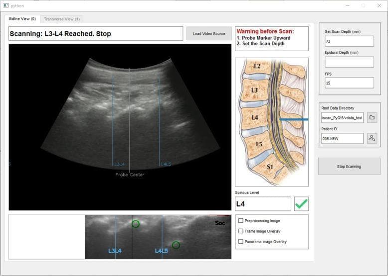 This image displays a specialized software interface for automated spinal ultrasound landmark identification, specifically a midline longitudinal view of the lumbar spine. The central component is a live ultrasound scan identifying the L3-L4 and L4-L5 interspinous spaces, marked with vertical blue lines and a central probe marker. Hyperechoic (bright) signals indicate bony surfaces of the vertebral bodies and posterior elements, while darker areas represent interspinous gaps. To the right, an anatomical diagram of the lumbar vertebrae (L2-S1) and the dural sac provides a visual reference for the scanning level. The software interface includes technical parameters such as scan depth (73 mm), frames per second (15 FPS), and epidural depth measurements. It facilitates clinical workflow for neuraxial anesthesia by identifying the spinous level (indicated as L4 with a green checkmark) and the optimal needle insertion site. A lower panoramic view displays labeled interspinous landmarks (L3L4, L4L5) with green circular highlights, demonstrating the system's tracking of spinal anatomy during the vertical probe movement.