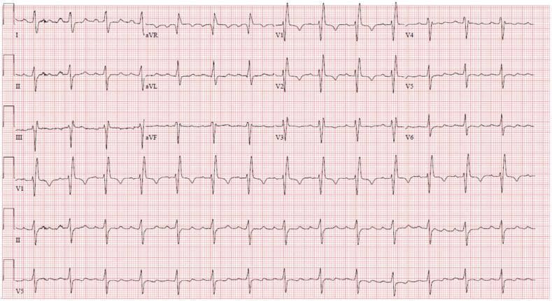 A standard 12-lead electrocardiogram (ECG) displayed in a 4x3 grid format with rhythm strips at the bottom. The tracing exhibits a regular sinus rhythm with a normal heart rate. Significant conduction abnormalities are present, characterized by a bifascicular block. A Right Bundle Branch Block (RBBB) is identified by widened QRS complexes (duration >120 ms) with a classic rSR' pattern in the right precordial leads (V1-V3) and slurred S-waves in the lateral leads (I, aVL, V5-V6). Concurrently, a Left Anterior Fascicular Block (LAFB) is indicated by a profound left axis deviation, with a positive QRS in lead I and negative QRS complexes in the inferior leads (II, III, and aVF). Secondary ST-segment and T-wave abnormalities, including T-wave inversion in V1-V3, are visible as a result of the altered ventricular depolarization. This visual is used to teach the recognition of complex intraventricular conduction delays and their implications for patient risk assessment in structural heart interventions.