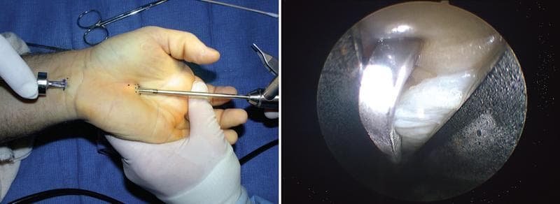 A composite image demonstrating biportal endoscopic carpal tunnel release (ECTR). The left side is a clinical photograph showing the surgical setup on a supinated human hand. Two portals are visible: a proximal port at the distal wrist crease and a distal port in the palm. An endoscope is inserted into the proximal portal, while a metallic surgical dissector is introduced through the distal portal, illustrating the 'two-portal' or Brown technique. The right side displays the corresponding internal endoscopic view of the carpal tunnel. The image shows the bright, white, fibrous bands of the transverse carpal ligament (TCL) and a metallic retrograde blade or dissector engaged with the tissue for transection. This visual captures the minimally invasive approach used to decompress the median nerve while minimizing surgical trauma to the palmar fascia and skin. The educational focus is on the instrumentation, portal placement, and internal visualization required for safe ligament release.