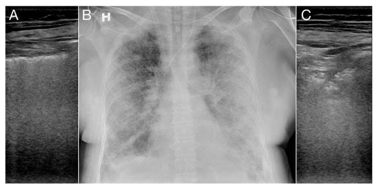 This composite diagnostic image features three panels comparing lung ultrasound (LUS) and chest X-ray findings in a patient with severe pulmonary pathology. Panel A is a lung ultrasound (lateral view) demonstrating interstitial edema, characterized by numerous, dense, hyperechoic vertical artifacts known as B-lines. These B-lines originate from the pleural line and extend to the bottom of the screen, obscuring normal horizontal A-lines. Panel B is a posterior-anterior chest X-ray showing diffuse bilateral opacities. Correlating with the ultrasound, the right lung shows Kerley B-lines (interstitial edema), while the left lung exhibits more dense subpleural opacities. Panel C is a corresponding lung ultrasound of the left lung showing pulmonary consolidation. This area displays a heterogeneous echotexture with hyperechoic, branching structures consistent with dynamic air-bronchograms within consolidated lung tissue. The image serves as an educational comparison between ultrasound artifacts (B-lines, air-bronchograms) and radiographic manifestations of COVID-19 related interstitial lung disease and consolidation.