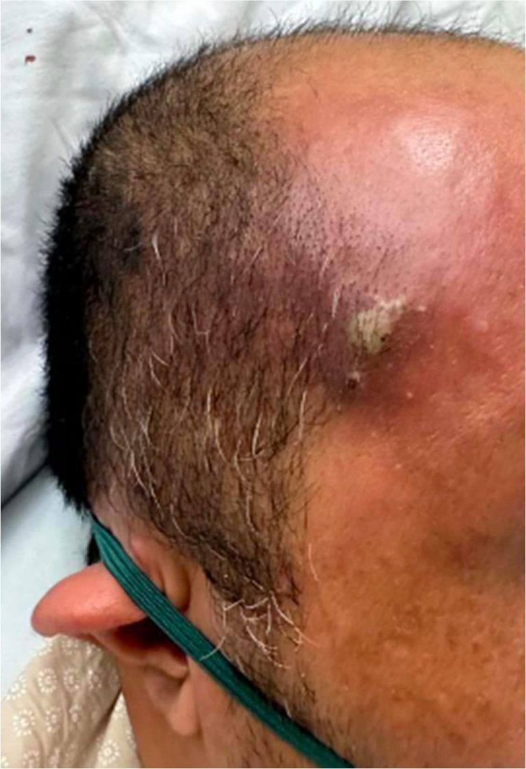 Clinical photograph showing a localized skin lesion, specifically a furuncle (boil), located on the right temporal/forehead region of a 44-year-old male. The lesion is characterized by an elevated, erythematous nodule approximately 1 cm in diameter, exhibiting central fluctuance and a small amount of yellowish-white purulent discharge (pus). There is significant surrounding perilesional erythema and soft tissue inflammation extending toward the scalp and forehead. The adjacent skin displays a slightly irregular texture with normal short hair distribution, including scattered graying. Clinically, such a lesion in a patient with poorly controlled diabetes mellitus can serve as a primary infectious nidus for hematogenous seeding, potentially leading to systemic complications such as septic pulmonary embolism (SPE). This image is used to demonstrate the morphology of a common cutaneous abscess and its potential role in the progression to sepsis.