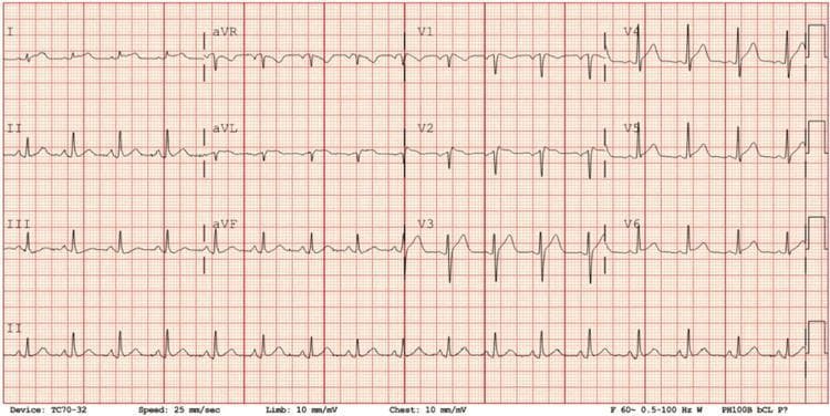 A 12-lead electrocardiogram (ECG) showing sinus tachycardia at approximately 101 beats per minute. The tracing displays the standard limb leads (I, II, III, aVR, aVL, aVF) and precordial leads (V1-V6) on standard red grid paper. Key diagnostic findings include diffuse, concave-upward ST-segment elevation visible in multiple leads (specifically leads I, II, aVF, and V2-V6), accompanied by reciprocal ST-segment depression in lead aVR. Additionally, there is characteristic PR-segment depression, most prominent in lead II, and reciprocal PR-segment elevation in lead aVR. These findings are classically indicative of acute pericarditis. The QRS complexes appear normal in duration and morphology, and there is a consistent P-wave before every QRS complex, confirming the sinus origin of the tachycardia.
