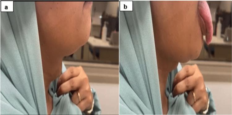 A two-panel clinical photograph illustrating a physical examination finding of a midline neck mass. Image (a) shows the lateral profile of a patient's neck at rest, revealing a smooth, rounded, subcutaneous swelling located in the midline near the hyoid region. Image (b) shows the same patient during tongue protrusion; the midline mass moves superiorly in coordination with the tongue movement. This specific physical sign (movement with tongue protrusion) is a classic clinical indicator of a thyroglossal duct cyst, reflecting its embryological attachment to the base of the tongue via the foramen cecum. The images are relevant for medical education in head and neck examination, surgical pathology, and endocrinology, specifically for differentiating midline neck masses such as dermoid cysts, ectopic thyroid tissue, and thyroglossal duct cysts.