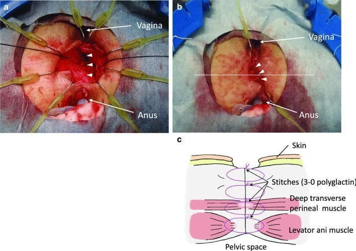 This composite figure consists of two intraoperative clinical photographs (6a and 6b) and a corresponding anatomical diagram (6c) illustrating the surgical repair of a rectovaginal fistula (RVF) via a perineal approach. Figure 6a shows the deep surgical field between the vagina and anus, where the innermost layer of dissected fibrous connective tissue is being sutured longitudinally with three interrupted stitches (indicated by arrowheads). Yellow surgical retractors provide exposure of the red, vascularized deep tissue. Figure 6b depicts a more superficial stage of the reconstruction, showing the outermost layer of tissue closed with another set of three stitches (arrowheads), creating an interposition layer between the vaginal and rectal lumens. A dotted line indicates the plane for the cross-sectional illustration. Figure 6c is a schematic diagram representing the multi-layered closure from the pelvic space to the skin. It identifies the anatomical structures involved in the reconstruction, including the levator ani muscle and the deep transverse perineal muscle, showing how 3-0 polyglactin sutures are used to approximate these layers in multiple tiers to reinforce the rectovaginal septum.