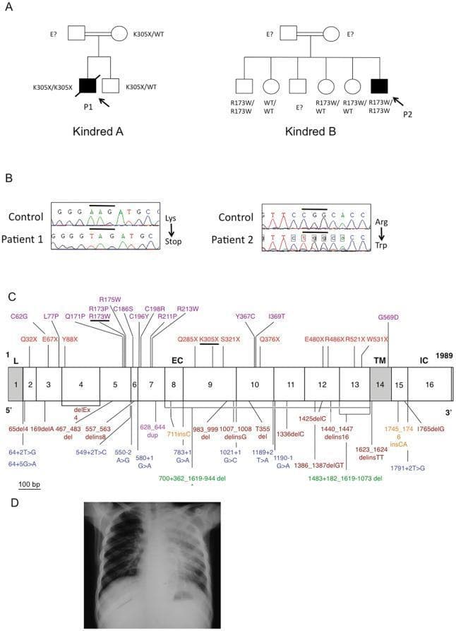 A multi-panel medical figure documenting Mendelian susceptibility to mycobacterial diseases (MSMD) caused by IL12RB1 mutations. Panel A: Pedigree charts for Kindred A and Kindred B showing an autosomal recessive inheritance pattern; affected individuals (black symbols) include probands P1 (K305X homozygote) and P2 (R173W homozygote) with severe Mycobacterium tuberculosis. Panel B: DNA sequencing electrophoregrams for Patients 1 and 2 compared to healthy controls, demonstrating the specific base pair substitutions. Panel C: A comprehensive schematic map of the IL-12R̡1 receptor protein coding region across 17 exons, depicting the leader (L), extracellular (EC), transmembrane (TM), and intracellular (IC) domains. The diagram color-codes various mutation types including missense, nonsense, splicing, and deletions, with the K305X and R173W mutations highlighted. Panel D: An anteroposterior chest X-ray of Patient 1 showing extensive bilateral opacification and consolidation primarily in the upper lobes, indicative of severe pulmonary tuberculosis.