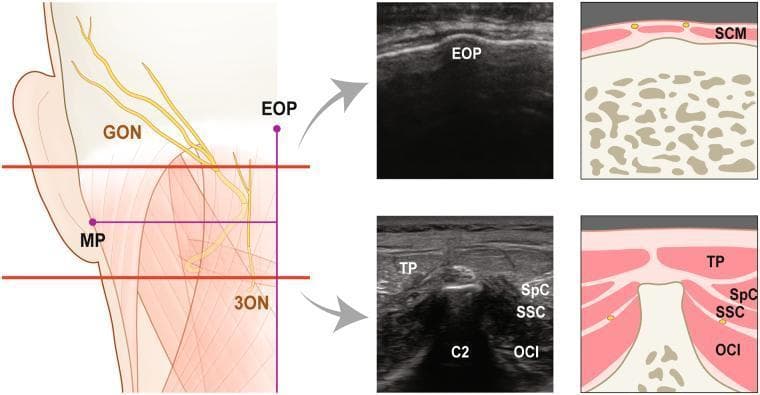 This composite educational image illustrates the topographical and sonographic anatomy of the occipital nerves for clinical blocks. The left panel features a cadaveric-style anatomical diagram of the posterior-lateral neck and scalp, highlighting the Greater Occipital Nerve (GON) and Third Occipital Nerve (3ON) in yellow. Key landmarks include the external occipital protuberance (EOP) and mastoid process (MP). Two horizontal red reference lines indicate levels for cross-sectional imaging: the upper line at the GON emergence from the trapezius (TP) and the lower line at the spinous process of the axis (C2). The right panel provides corresponding transverse ultrasound images and schematic diagrams at these two levels. The superior section identifies the EOP and sternocleidomastoid (SCM). The inferior section at C2 demonstrates the layered musculature: the superficial trapezius (TP), followed by the splenius capitis (SpC), semispinalis capitis (SSC), and the deepest layer, the obliquus capitis inferior (OCI). Small yellow dots in the diagrams pinpoint nerve locations relative to these muscle planes, aiding in ultrasound-guided anesthetic procedures.