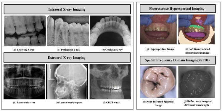 A comprehensive compilation of dental imaging modalities categorized into four sections. The first section, Intraoral X-ray Imaging, displays (a) Bitewing X-rays for interproximal caries detection, (b) Periapical X-rays showing the whole tooth and surrounding bone, and (c) Occlusal X-rays visualizing larger segments of the arch. The second section, Extraoral X-ray Imaging, includes (d) Panoramic X-rays for a broad view of the maxilla and mandible, (e) Lateral Cephalograms for orthodontic analysis of craniofacial structures, and (f) CBCT X-ray for 3D volumetric reconstruction. The third section illustrates Fluorescence Hyperspectral Imaging with (g) a standard hyperspectral image and (h) a soft tissue labeled version for tissue differentiation. The final section demonstrates Spatial Frequency Domain Imaging (SFDI) with (i) a near-infrared spectral image of an occlusal surface and (j) a reflectance image at different wavelengths. This figure serves as an educational overview of diagnostic tools used for assessing dental anatomy, pathology, and soft tissue health in dentistry and maxillofacial surgery.