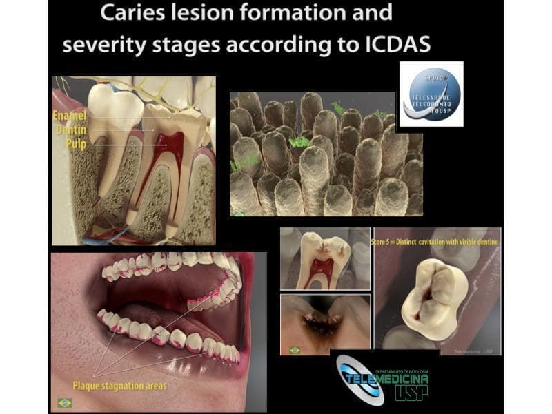 Educational infographic and 3D animation stills from the Virtual Man Project regarding caries lesion formation and severity stages according to the International Caries Detection and Assessment System (ICDAS). The visual contains four main sections: (1) A sagittal cross-section of a human tooth labeling primary anatomical layers including the enamel (outer white layer), dentin (middle beige-brown layer), and pulp chamber (central red vascular tissue). (2) A microscopic view representing dental biofilm or enamel rods. (3) A clinical 3D model of a human mouth with the mandible and maxilla, highlighting 'plaque stagnation areas' in red along the cervical margins (gumline) and interproximal spaces. (4) A panel demonstrating clinical progression of caries, including a view of 'Score 5: Distinct cavitation with visible dentine' on an occlusal surface. This resource is designed for dental education, illustrating the pathophysiology of demineralization, biofilm accumulation, and the standardized classification of dental decay severity.
