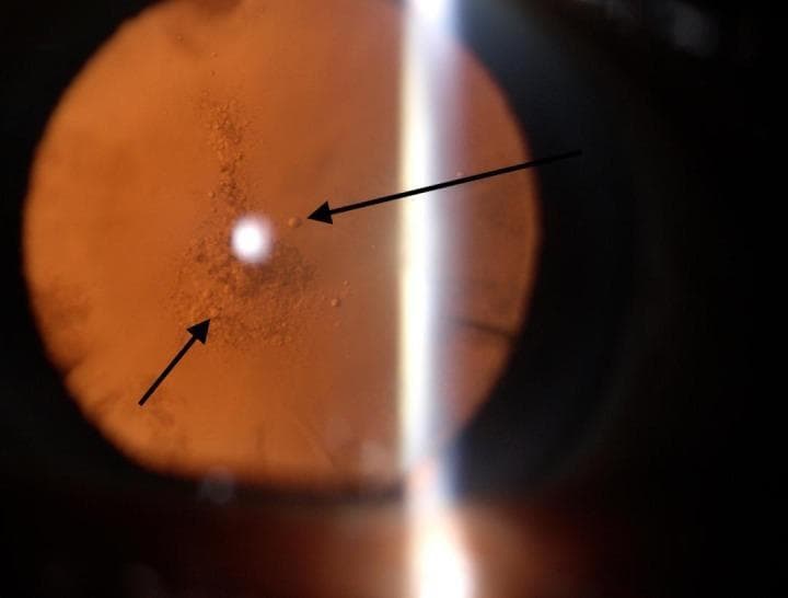 This clinical photograph displays a posterior subcapsular cataract (PSC) viewed under slit-lamp biomicroscopy. The image reveals a characteristic granular, 'pearl-like' opacification located in the posterior subcapsular region of the crystalline lens. Black arrows highlight these discrete, small, rounded opacities, which appear more concentrated centrally and toward the lower quadrant. The overall lens exhibits an amber-to-light-brown hue, suggestive of co-existing nuclear sclerosis. A vertical light reflex from the slit-lamp source is visible on the right side of the frame, providing retroillumination that accentuates the hazy, plaque-like distribution of the cataract. This finding is highly relevant in ophthalmology for diagnosing vision impairment related to posterior lens pathology, often associated with prolonged corticosteroid use, diabetes, or ionizing radiation exposure. The image demonstrates the visual obstruction and light scattering caused by these subcapsular changes.