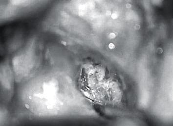 This intraoperative clinical photograph captures a surgical procedure in the otolaryngology domain, specifically an approach to the petrous apex. The image demonstrates a modified superior semicircular canal that has been surgically plugged, sealed, and partially amputated to facilitate access. The central focus is the petrous apex, where a cholesteatoma matrix is visible prior to its excision. Key anatomical landmarks include the exposed mastoid cavity and the deep surgical field of the temporal bone. The image illustrates advanced skull base surgery techniques, specifically the intentional occlusion of the semicircular canal as a pathway to reach deep-seated lesions of the petrous apex while attempting to preserve surrounding neural and inner ear structures. The photograph serves as an educational resource for understanding the surgical management of complex cholesteatomas and the necessary modifications to vestibular anatomy required for petrous apex exposure.